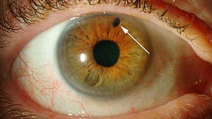 Dr. Rafael Mérula publica artigo sobre glaucoma em revista eletrônica de oftalmologia