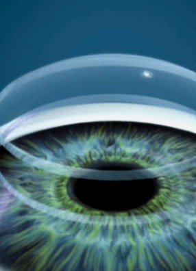 Transplante de Córnea